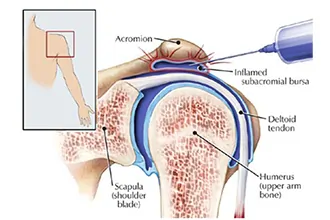 bursa-injections-tampa-fl