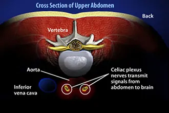 celiac-plexus-block-and-neurolysis-tampa-fl