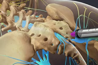 epidural-steroid-injections-tampa-fl