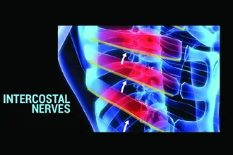 intercostal-nerves-block-and-rfa-tampa-fl