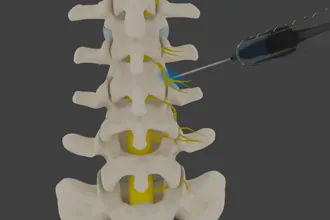 medial-branch-block-tampa-fl