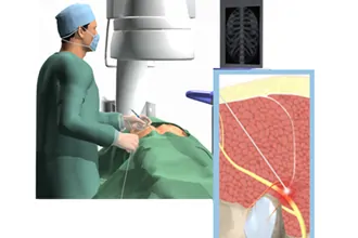 radiofrequency-ablation-tampa-fl