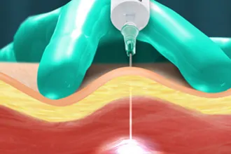 trigger-point-injections-tampa-fl